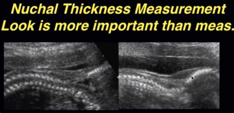 nuchal thickness should not be measured after 20.6 weeks|nuchal fold thickness results.